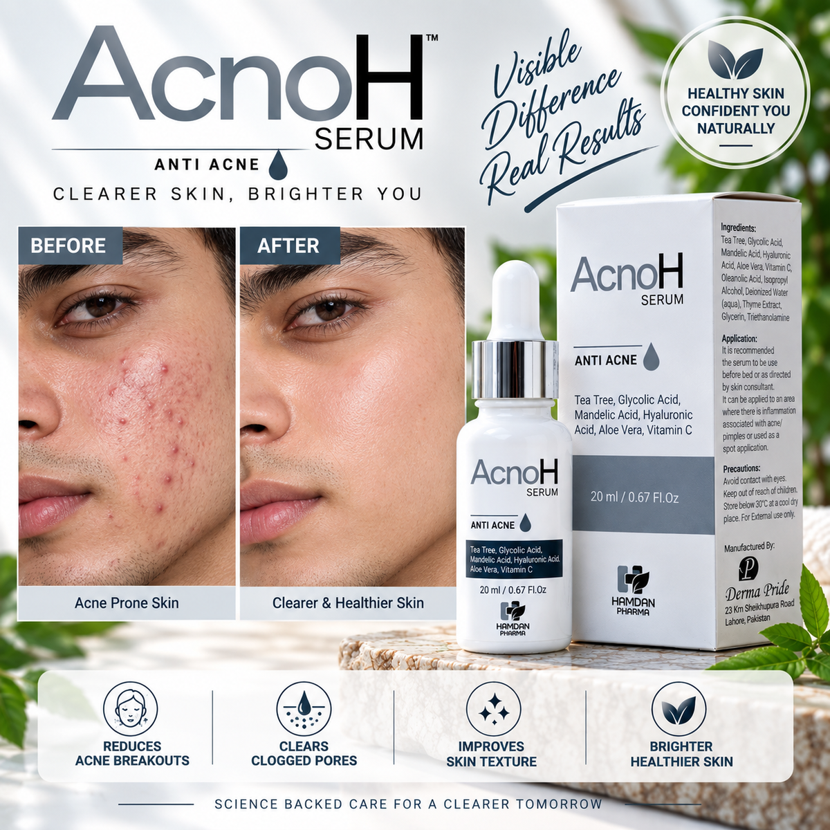 AcnoH Serum – Anti Acne Serum 20ml