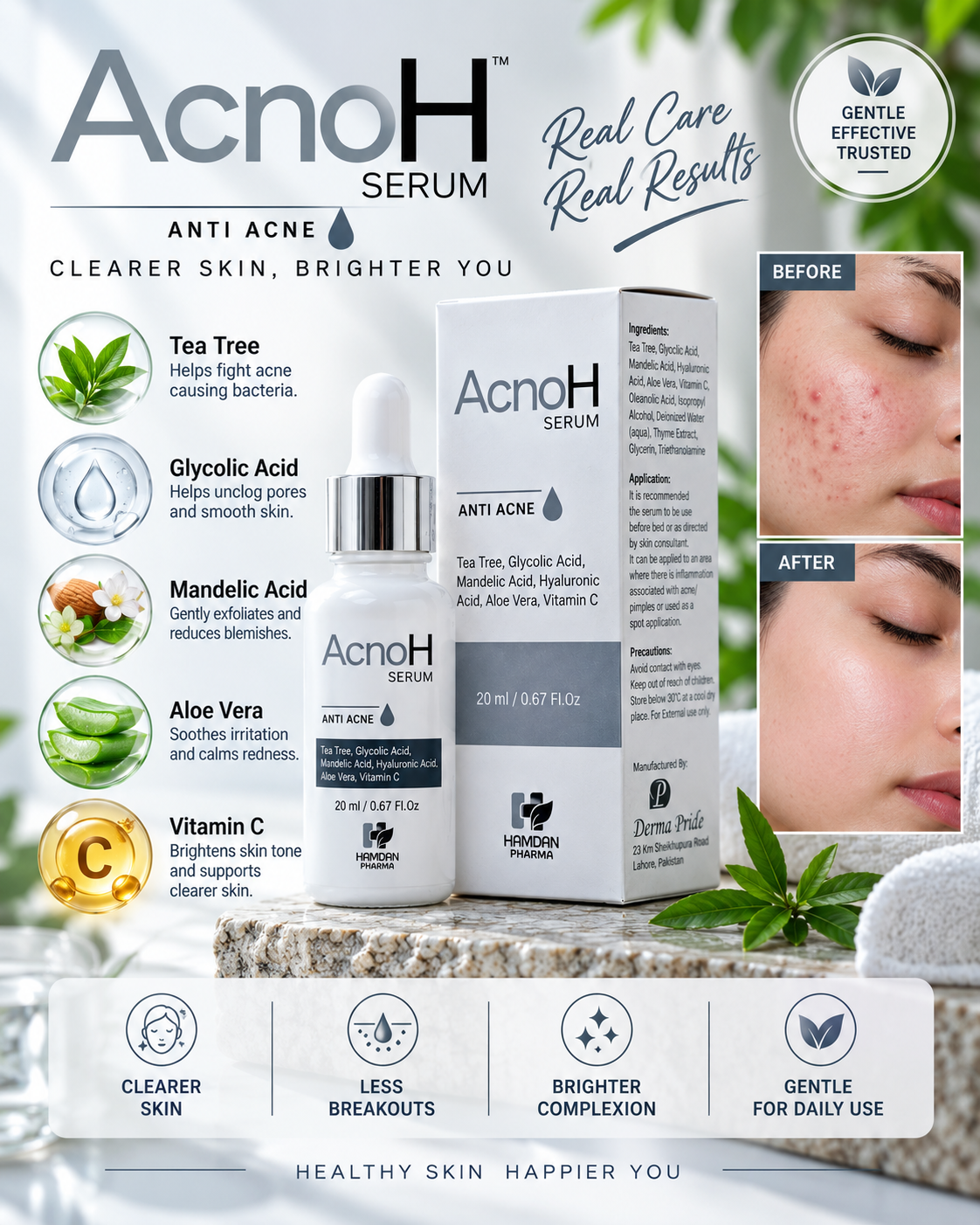 AcnoH Serum – Anti Acne Serum 20ml